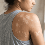 Jenis Panu Kenali Penyebab dan Cara Mencegahnya