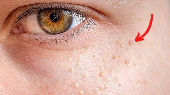 Cara Menghilangkan Milia dengan Aman, Ini Treatment Efektif