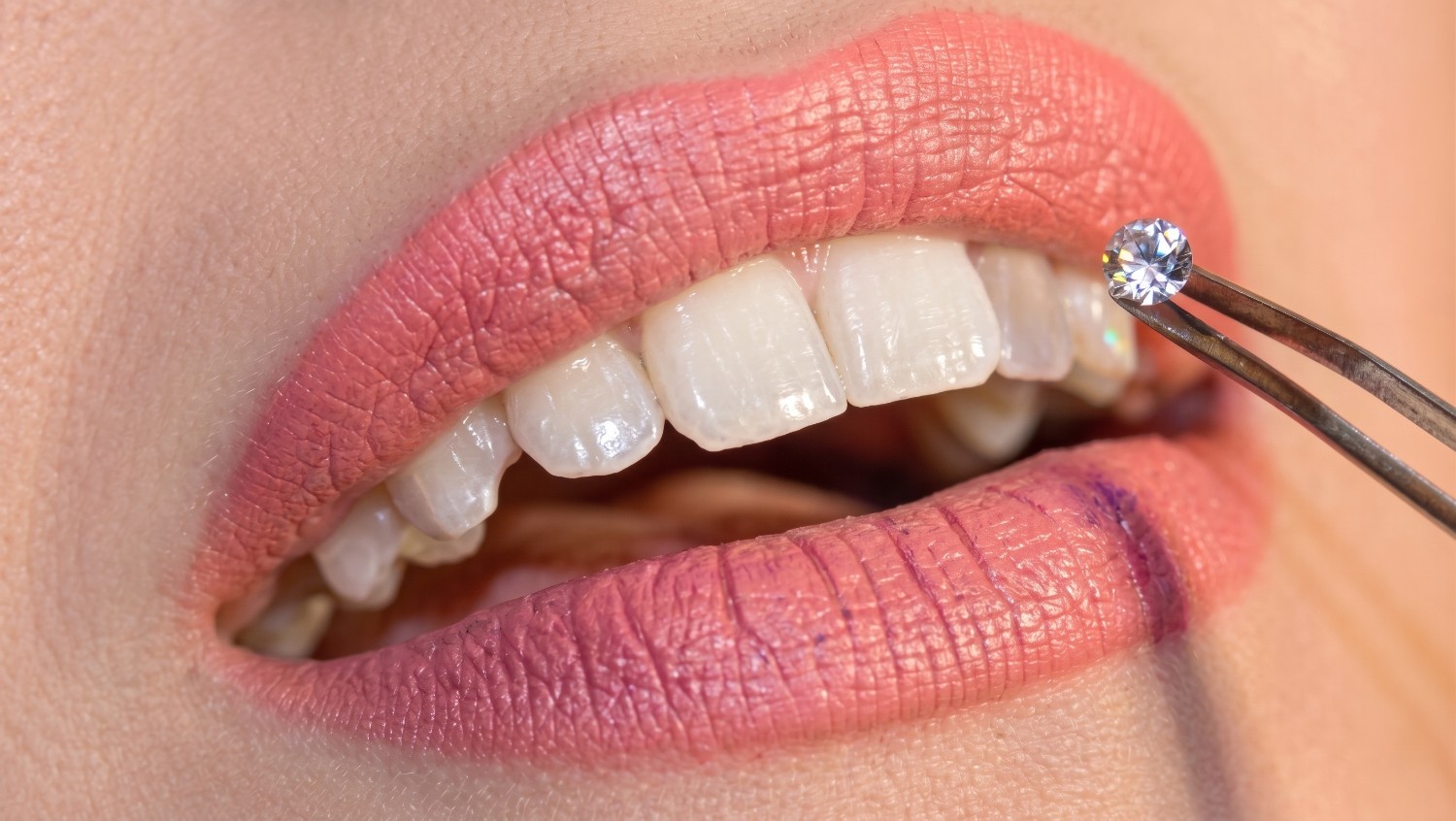 Tooth Gem Jadi Tren Gen Z, Aman atau Berisiko
